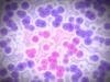 New Research Tool Could Lead to Improved Targeted Therapies for Acute Myeloid Leukemia