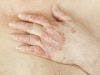 Researchers Discover Genetic Differences Between Cutaneous Psoriasis and Psoriatic Arthritis