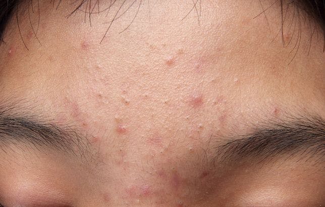 Acne Can Be Troublesome But Responds to Treatment