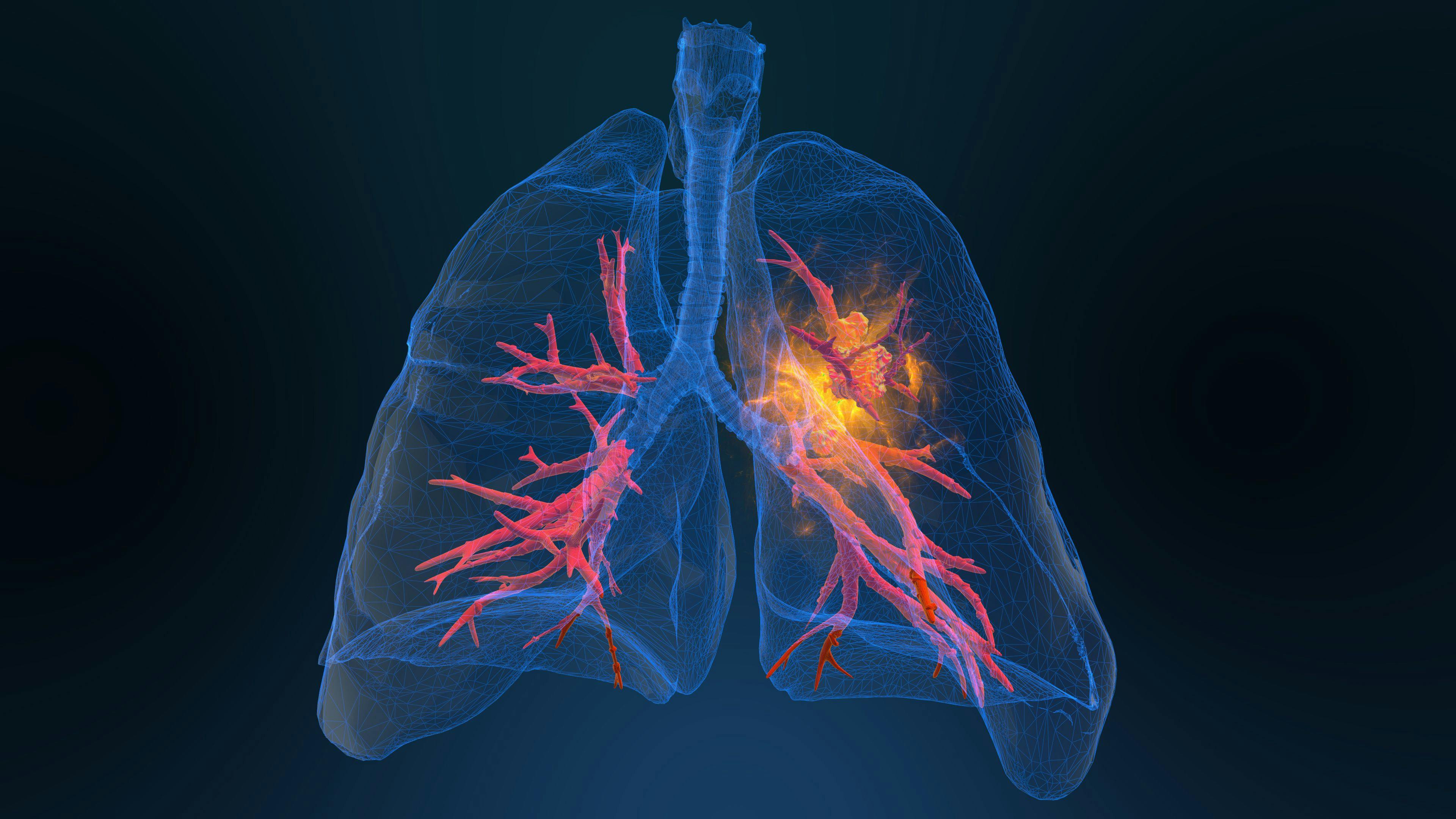 3d rendered illustration of lung cancer 3D illustration | Image Credit: appledesign - stock.adobe.com