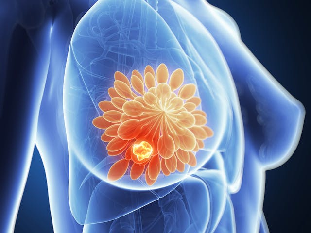 X-ray image of tumor in breast -- Image credit: Sebastian Kaulitzki | stock.adobe.com