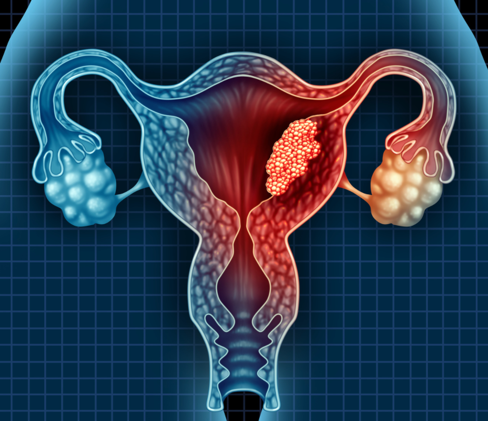 Black, Hispanic Patients Underrepresented in Clinical Trials Cited in NCCN Guidelines for Endometrial Cancer Systemic Therapy Regimens 