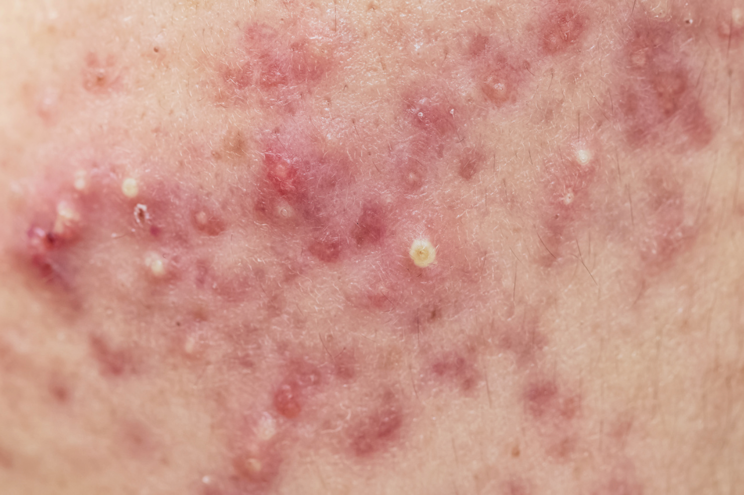 Study: Dupilumab Significantly Improves Itch, Hives in Patients With Chronic Spontaneous Urticaria