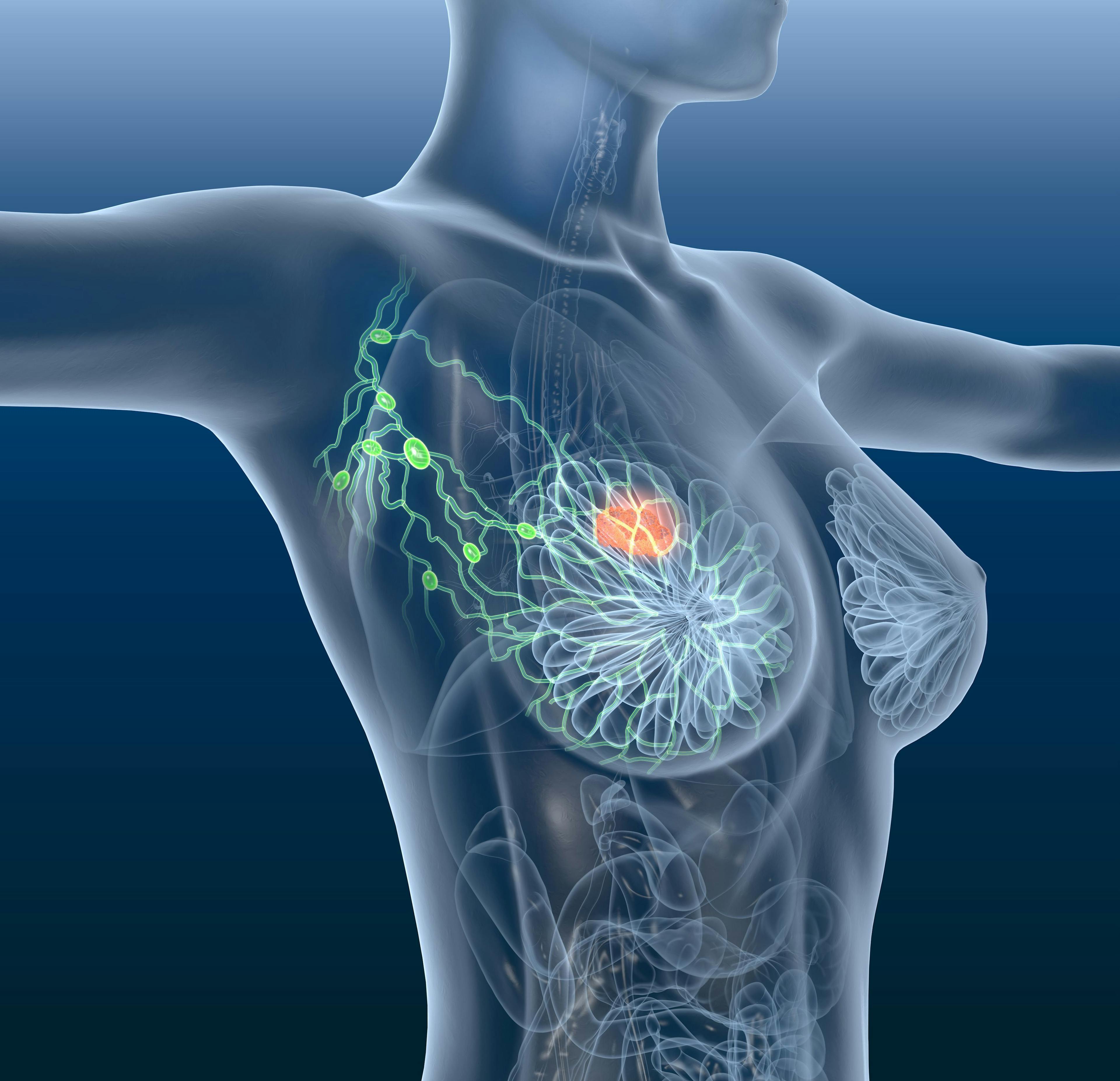 Breast cancer, lymphatics, mastocarcinoma | Image Credit: Axel Kock - stock.adobe.com