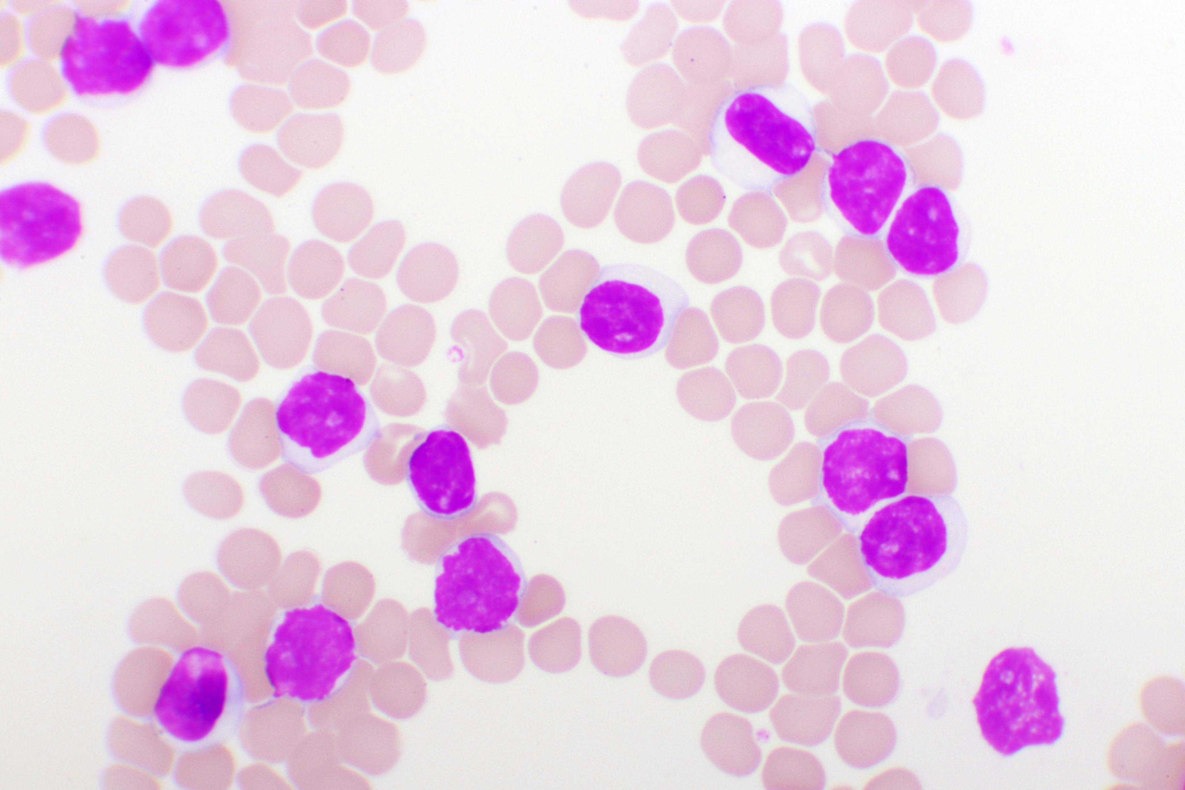 Expert Addresses Add-On Approach For the Treatment of Chronic Lymphocytic Leukemia