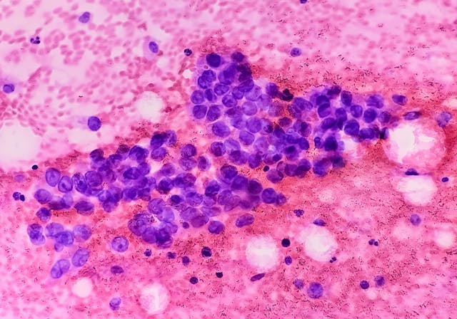 Photomicrograph of fine needle aspiration (FNA) cytology of a pulmonary (lung) nodule showing adenocarcinoma, a type of non small cell carcinoma - Image credit: Saiful52 | stock.adobe.com