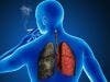Lung Cancer Surpasses Breast Cancer as Leading Cause of Cancer Death in Females