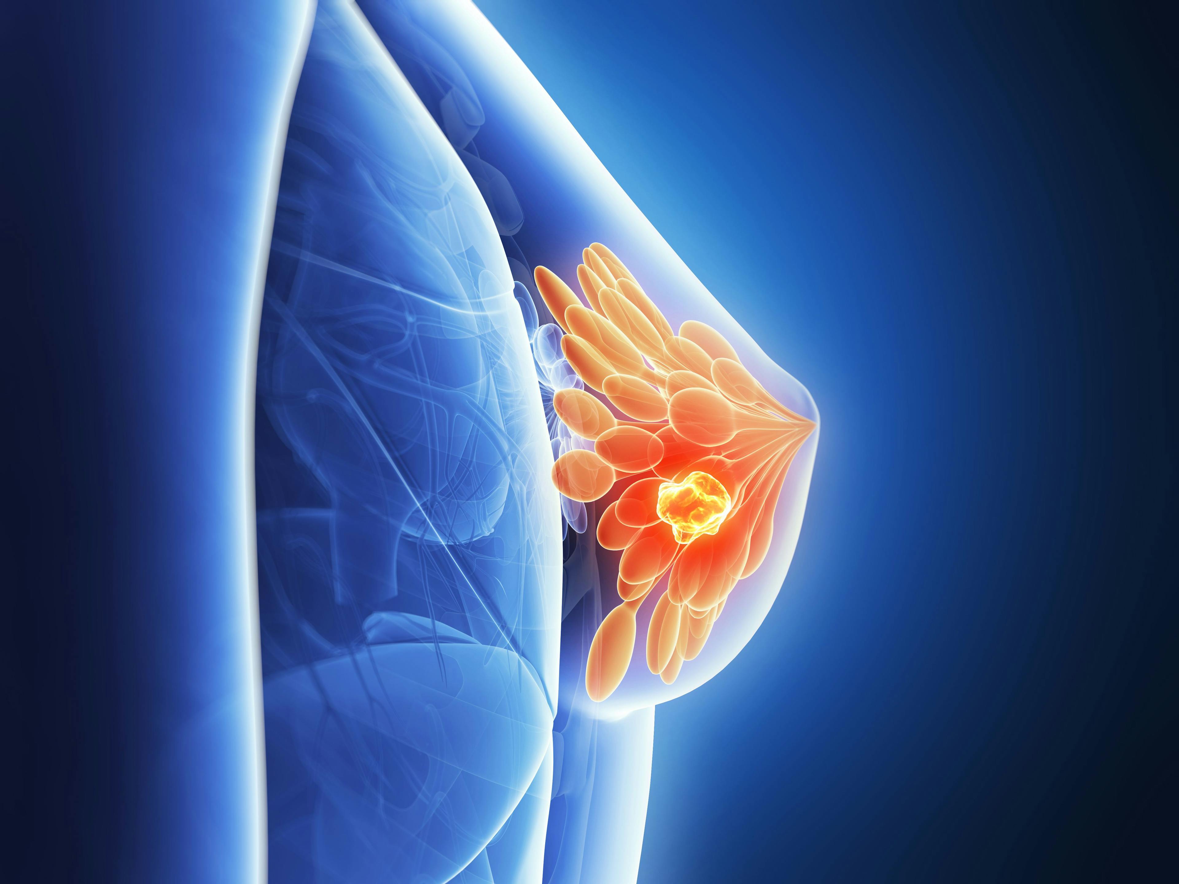 3d rendered illustration - breast cancer | Image Credit: SciePro - stock.adobe.com