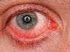 Common Rheumatoid Arthritis Drug Effective in Treating Rare Eye Disease