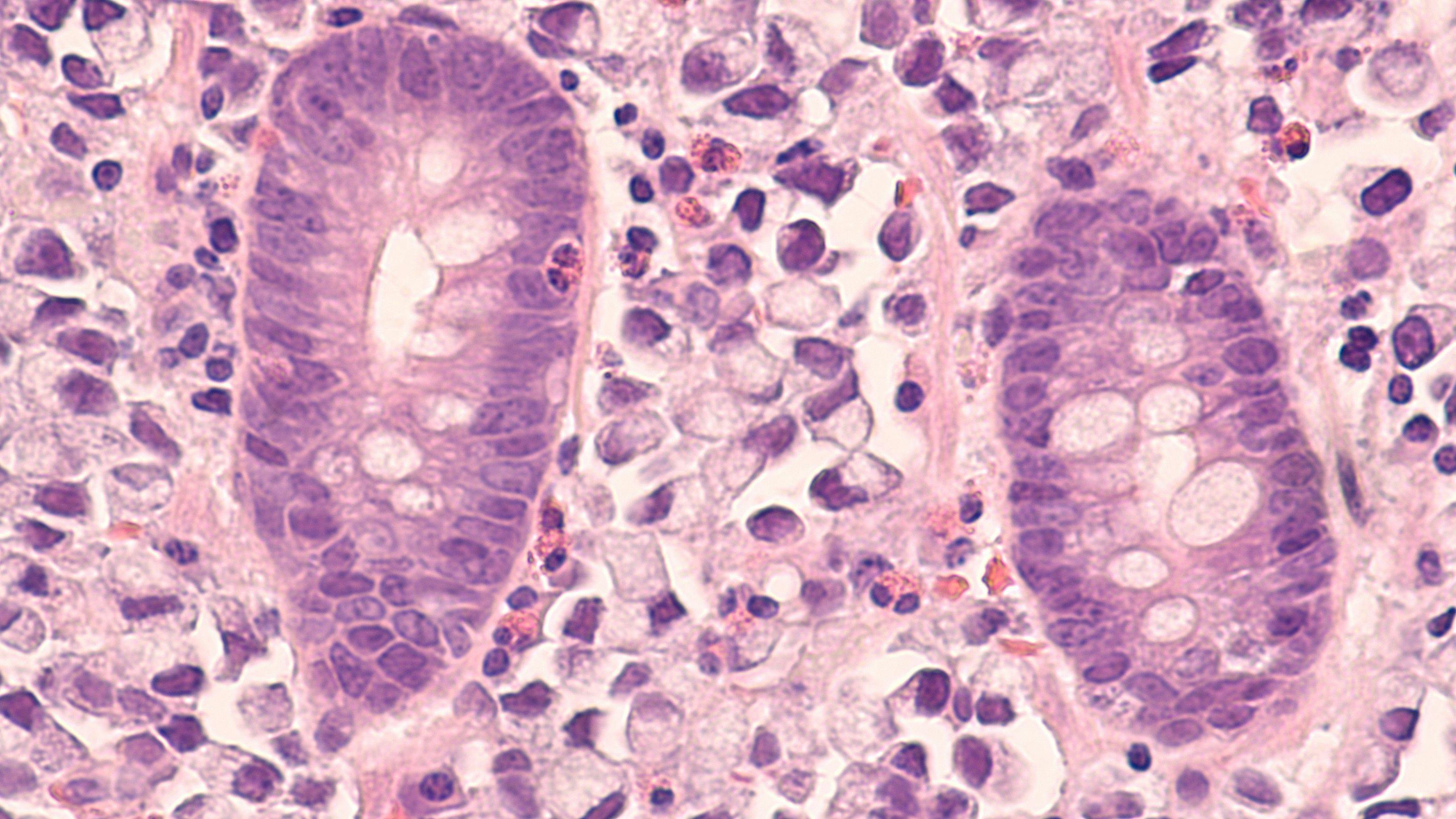 Microscopic image of a stomach cancer (poorly differentiated gastric adenocarcinoma, mucinous signet ring type), metastatic to colon - Image credit: David A Litman | stock.adobe.com