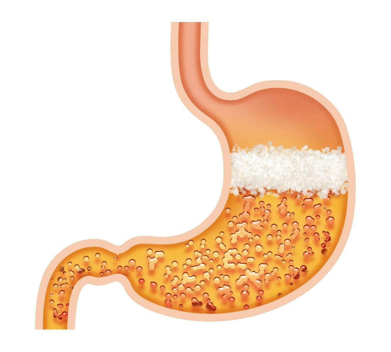 Proton Pump Inhibitors: How to Deprescribe These Nutrient Robbers 