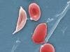FDA Grants Breakthrough Designation to Treatment for Sickle Cell Disease