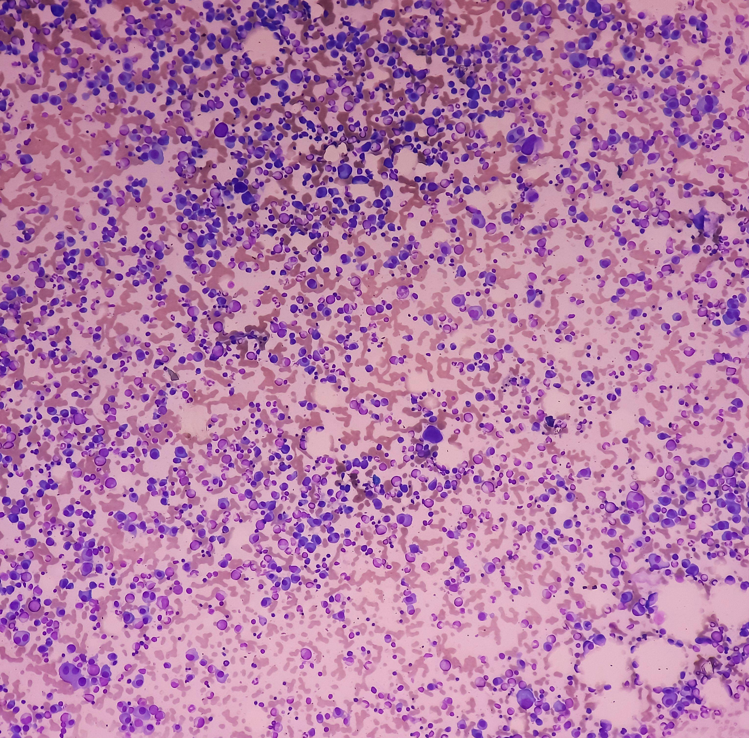 Microscopic image of bone marrow. Plasma cell dyscrasia or Multiple myeloma. A type of bone marrow cancer of malignant plasma cells. Credit: MdBabul - stock.adobe.com 