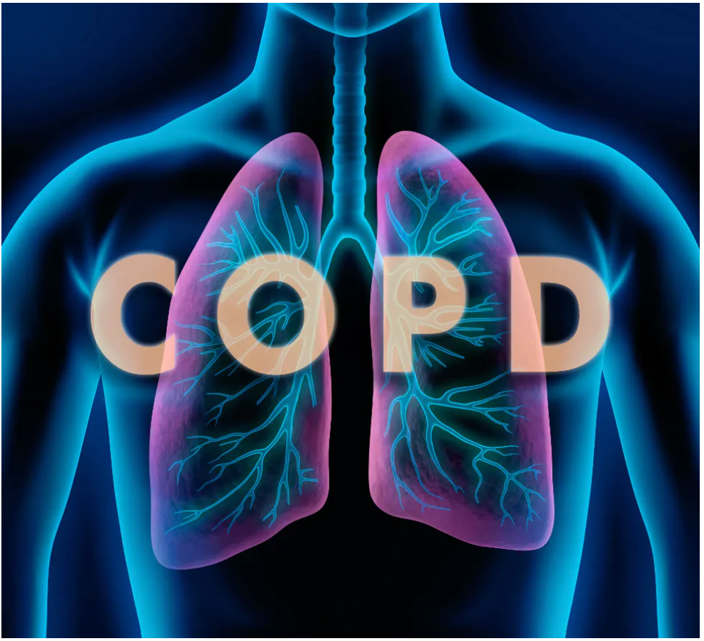 Dupilumab has been shown to be safe and effective for patients with COPD and uncontrolled type 2 inflammation. Credit: peterschreiber.media - stock.adobe.com.