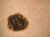 Analysis: Skin Cancer Risks, Recurrence, Metastasis, and Death