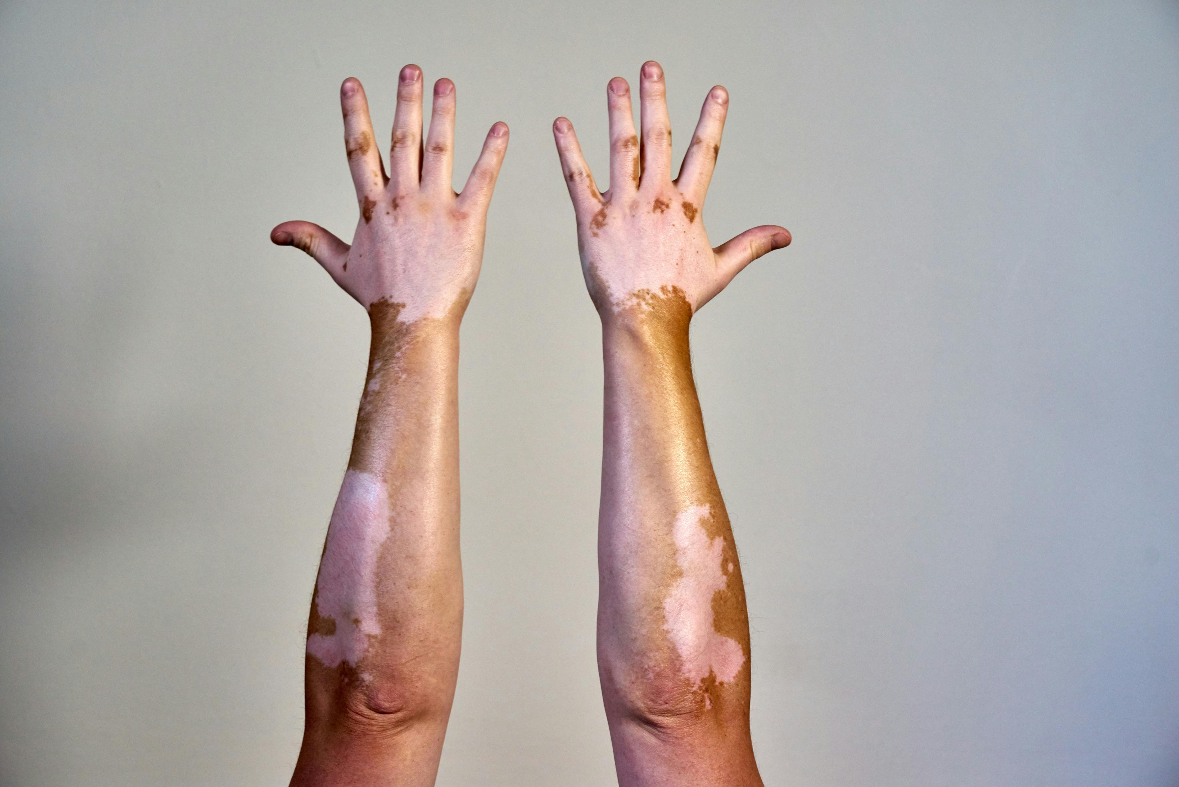 Vitiligo skin disease on male hands | Image Credit: Chris West/Wirestock Creators - stock.adobe.com