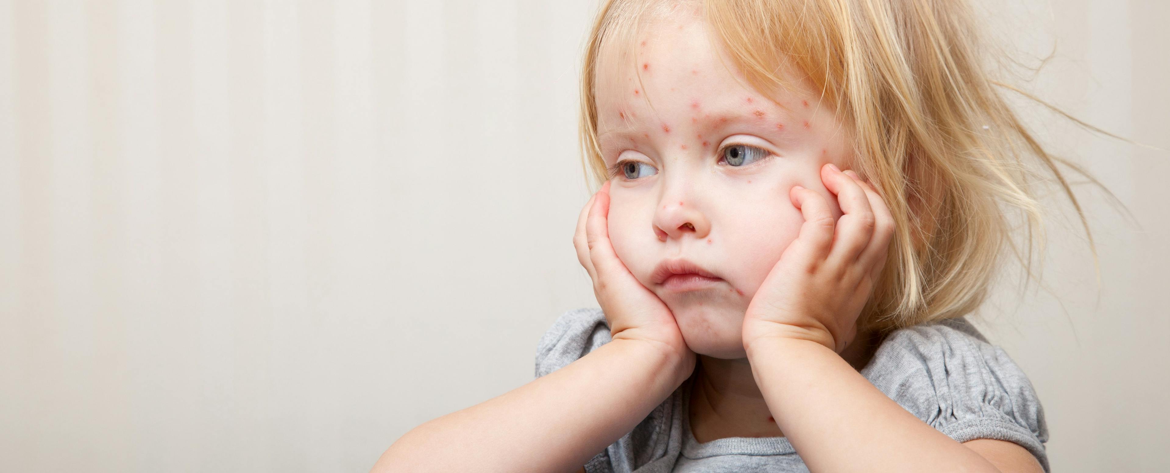 "Holes in the Herd" Linked to Measles Spread