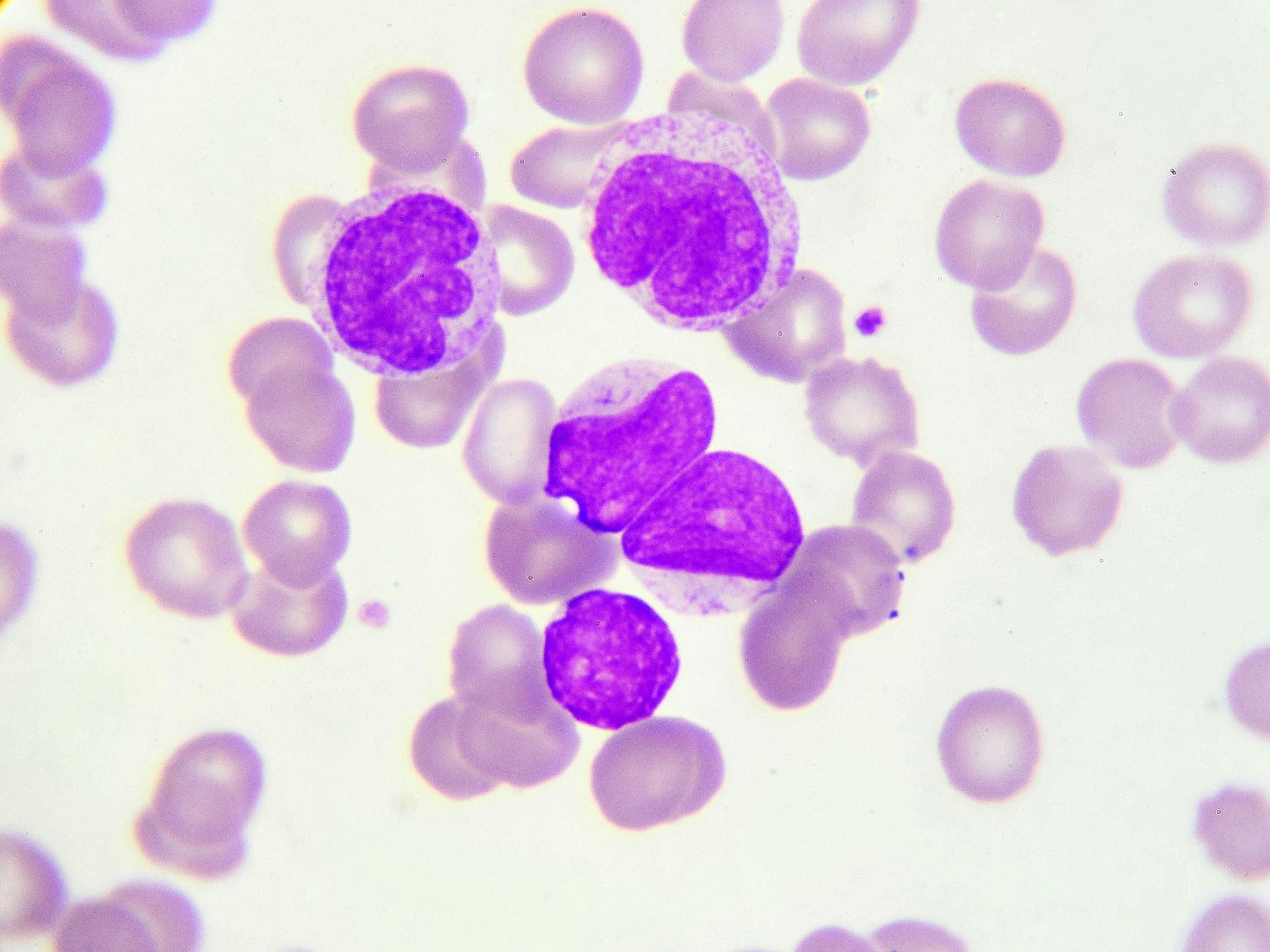 Expert: METTL3 Is Essential for Growth in Aggressive Chronic Lymphocytic Leukemia