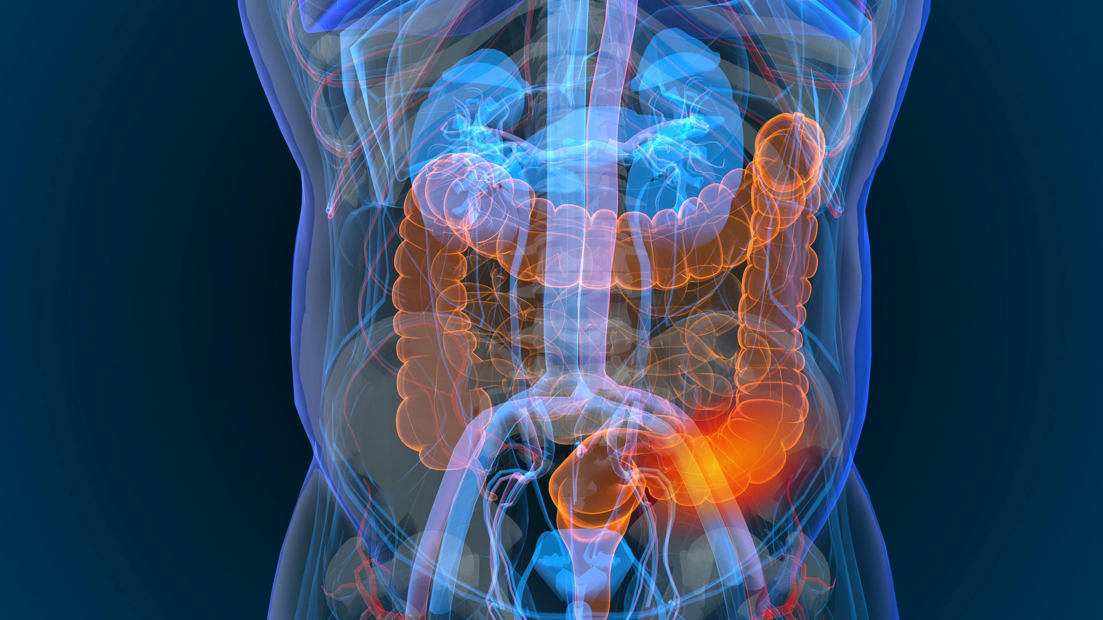 3d rendered illustration of bowel cancer 3D illustration | Image Credit: appledesign - stock.adobe.com