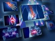 Celecoxib May Be Safer Than Other Arthritis Treatments