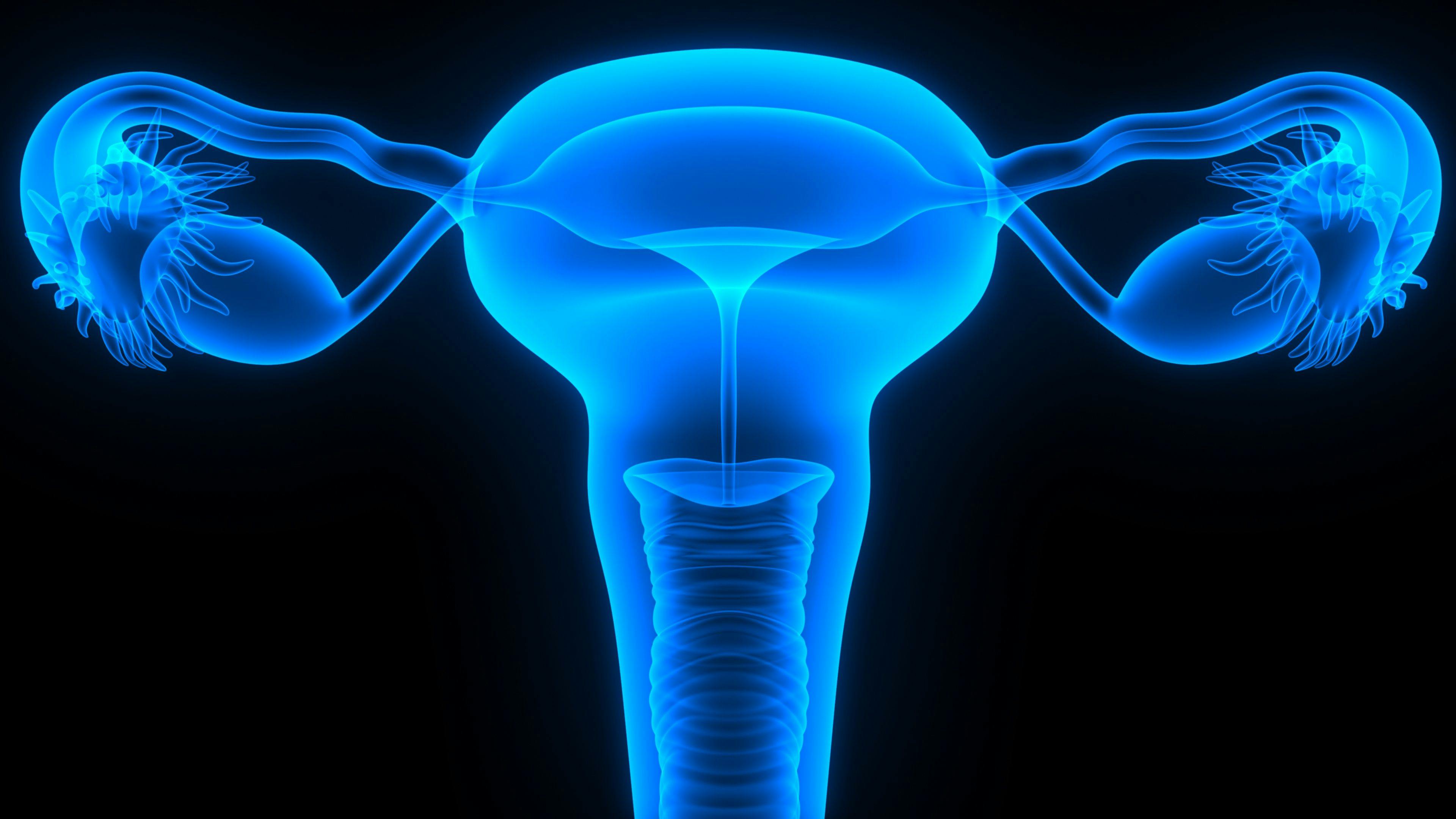 Expert: Consider Dose Intensity With PARP Inhibitors for Ovarian Cancer