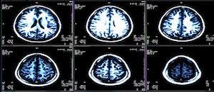 Evidence Lacking for Drug Treatment of Multiple Sclerosis-Related Cognitive Impairment
