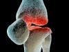 Stem Cell Therapies for Replacing Cartilage in Arthritis