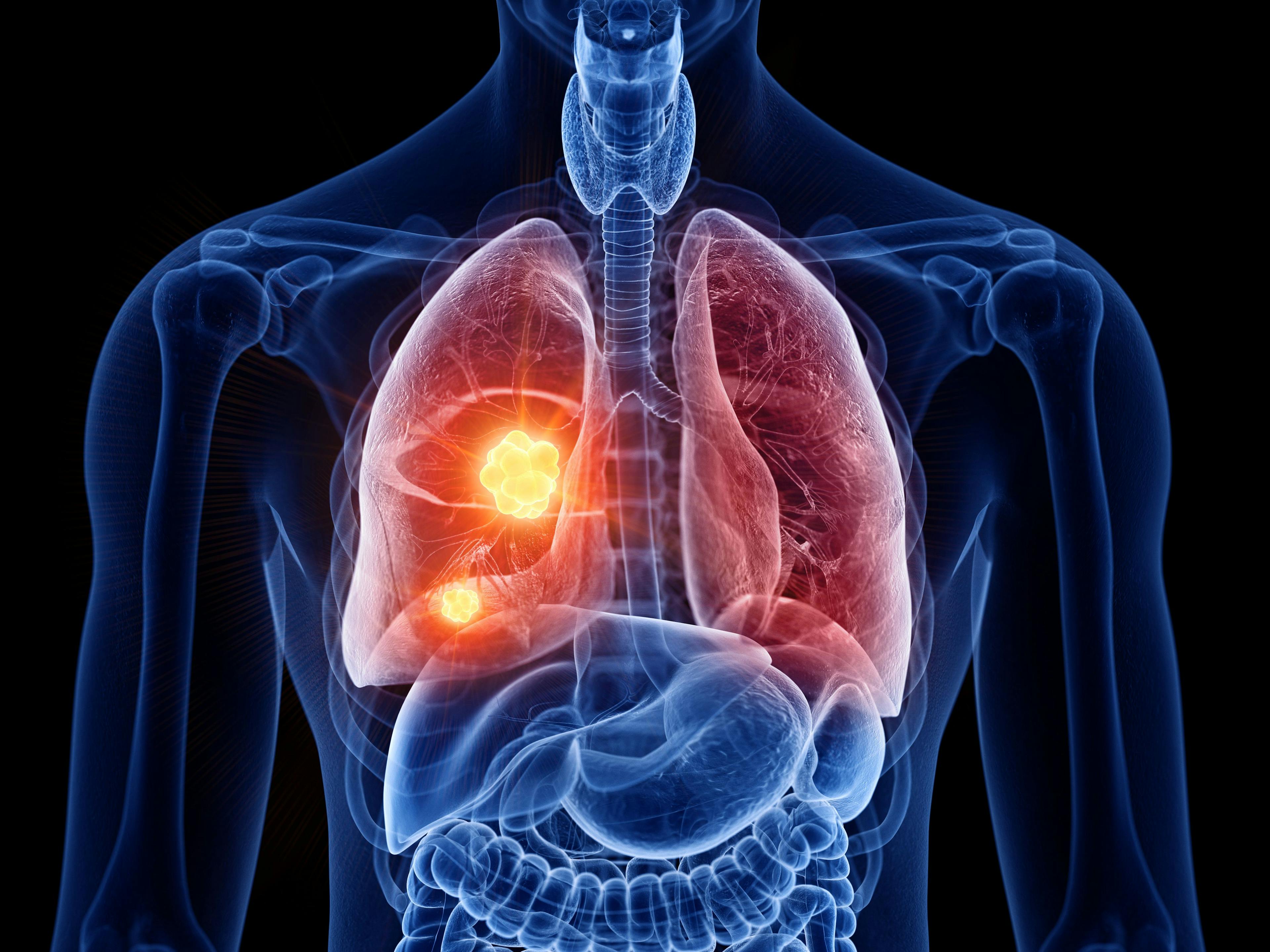 3d rendered medically accurate illustration of lung cancer | Image Credit: Sebastian Kaulitzki - stock.adobe.com