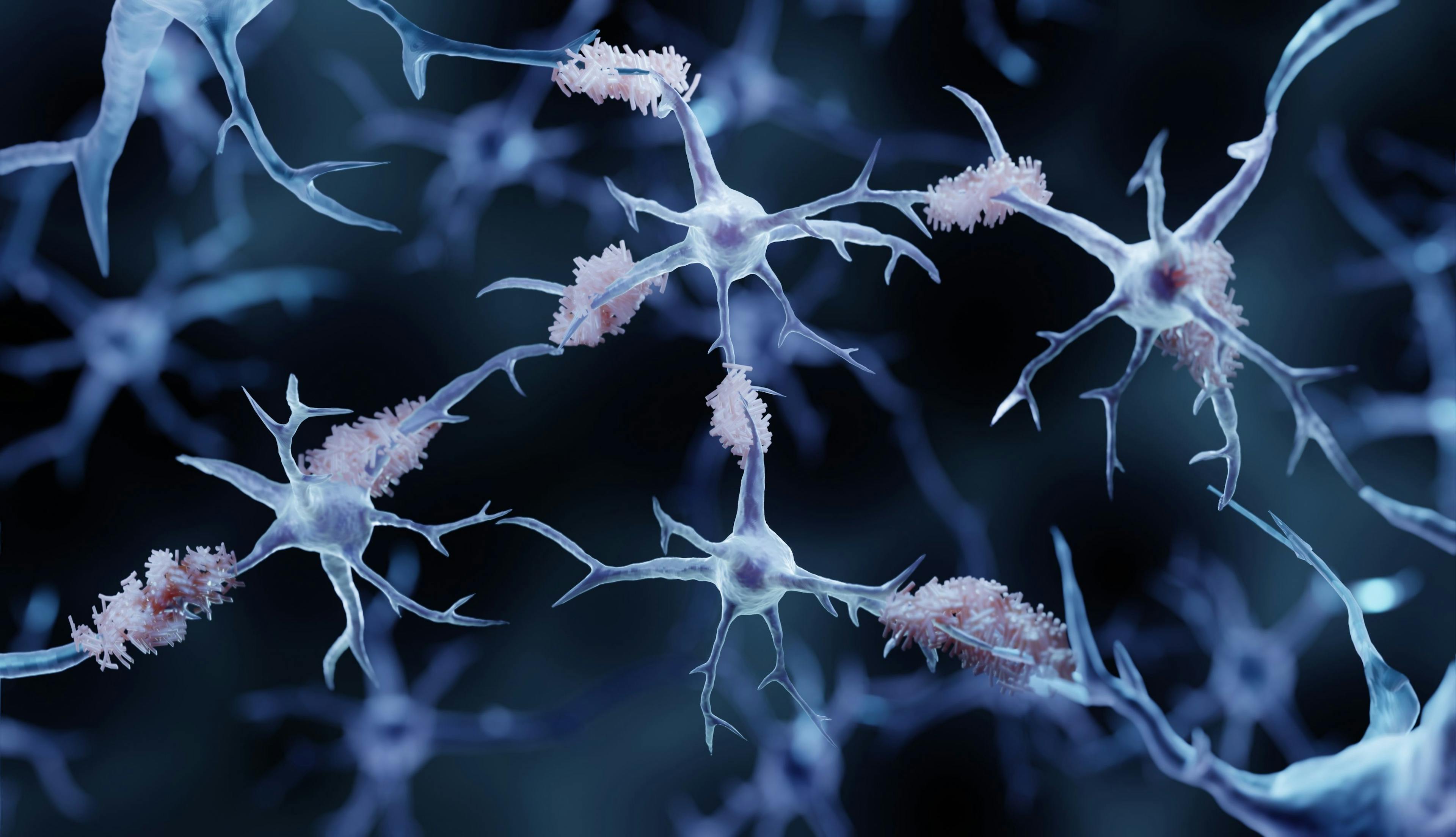 Amyloid plaques in Alzheimer's disease | Image Credit: Artur - stock.adobe.com