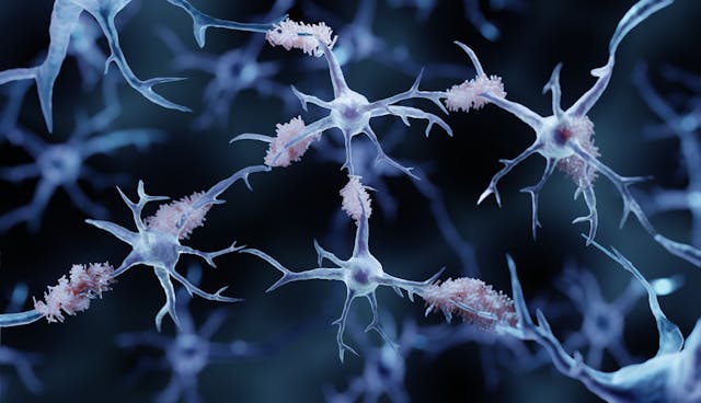Plaque on neurons depicting Alzheimer disease -- Image credit: Artur | stock.adobe.com