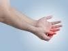 New MAB Safe in Rheumatoid Arthritis Patients