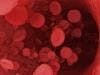 Blood Cancer Drugs Overpriced 
