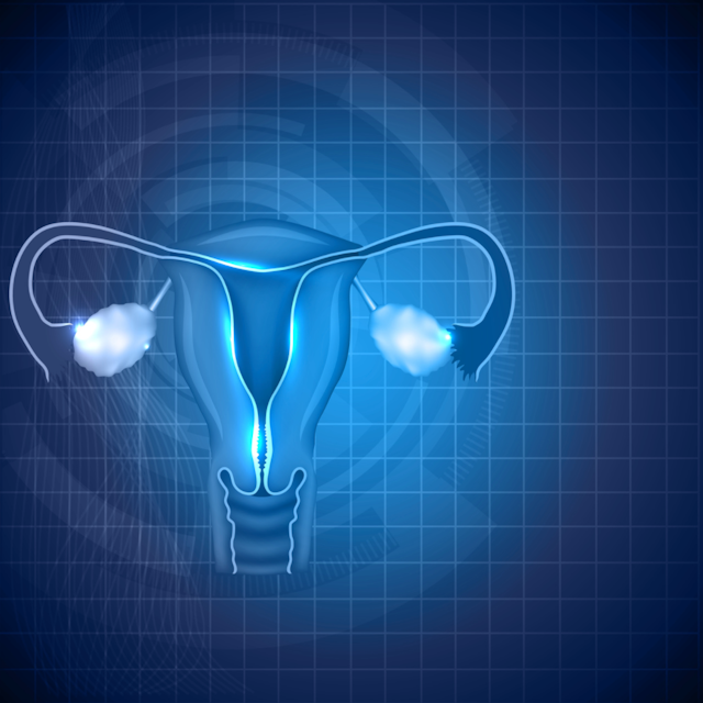 Frequent Aspirin May Reduce Risk of Ovarian Cancer for People With Genetic Susceptibility 
