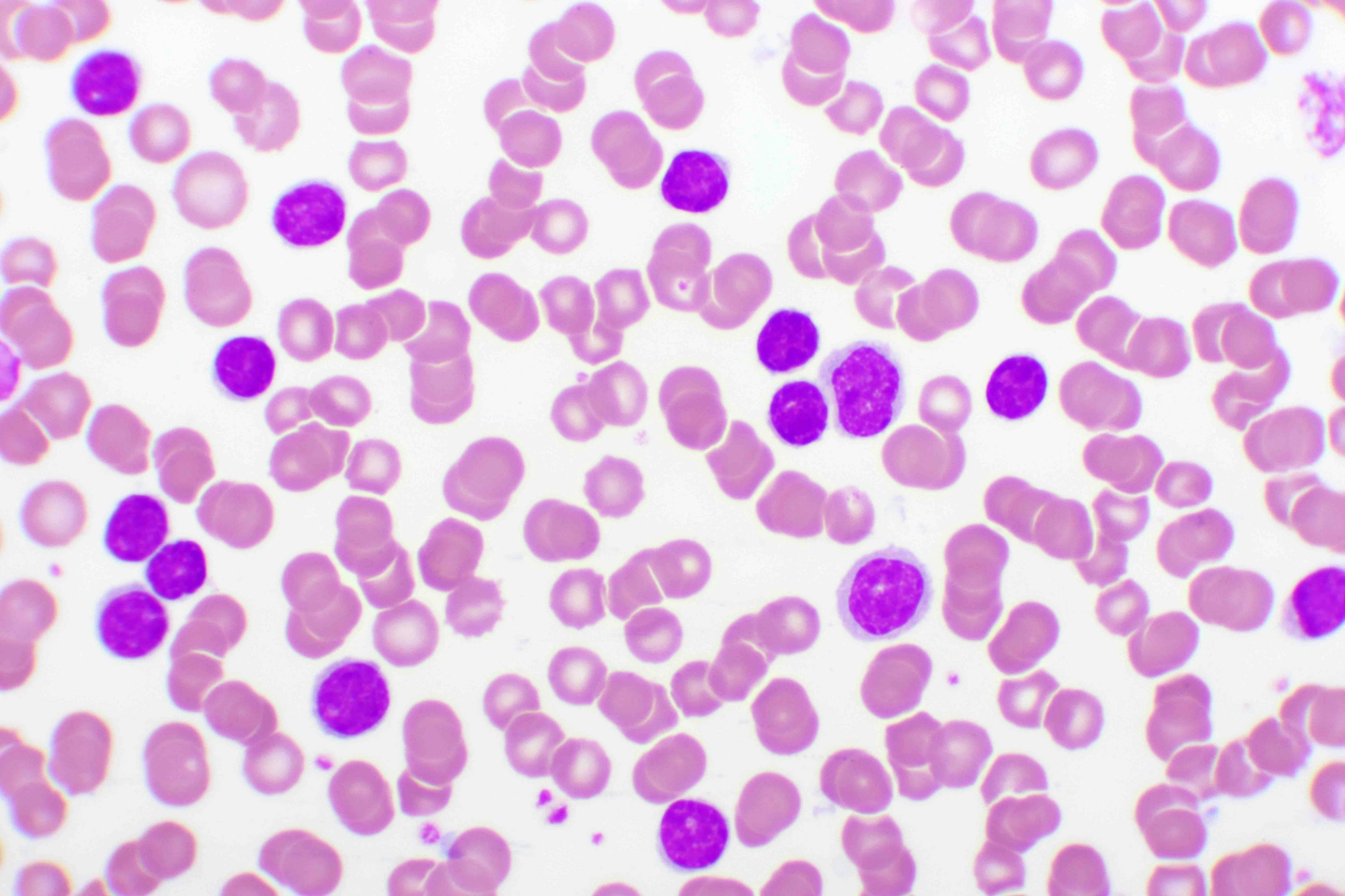 Experts Outline Best Practices in the Treatment of Chronic Lymphocytic Leukemia
