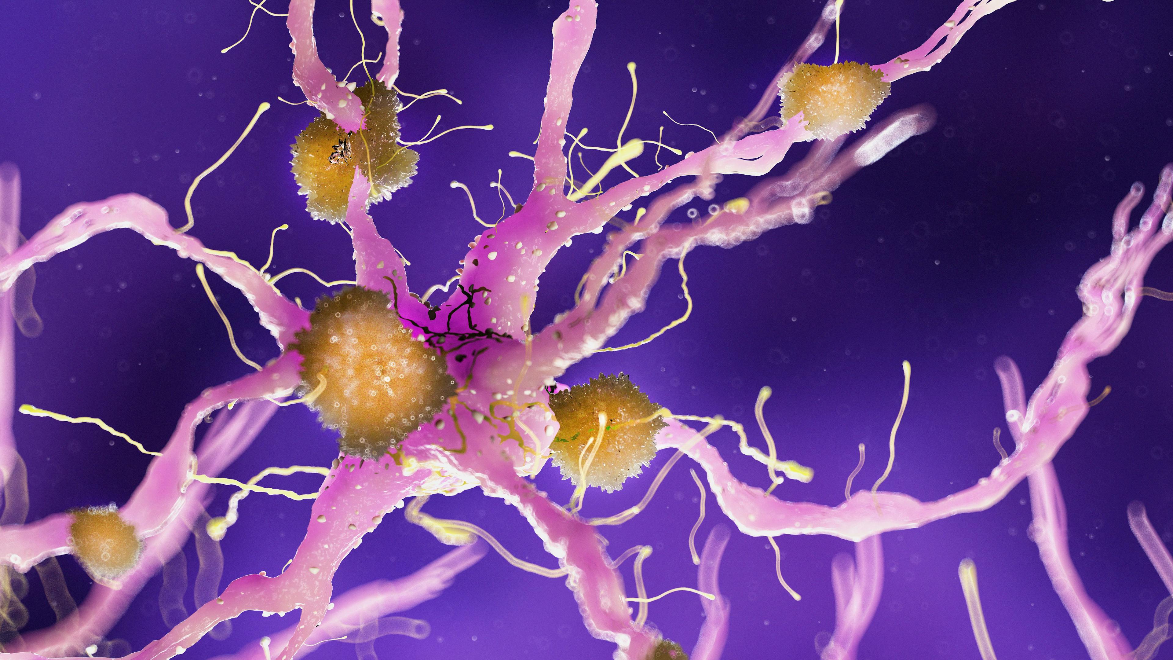 3d rendered medically accurate illustration of amyloid plaques on a alzheimer nerve cell | Image Credit: Sebastian Kaulitzki - stock.adobe.com