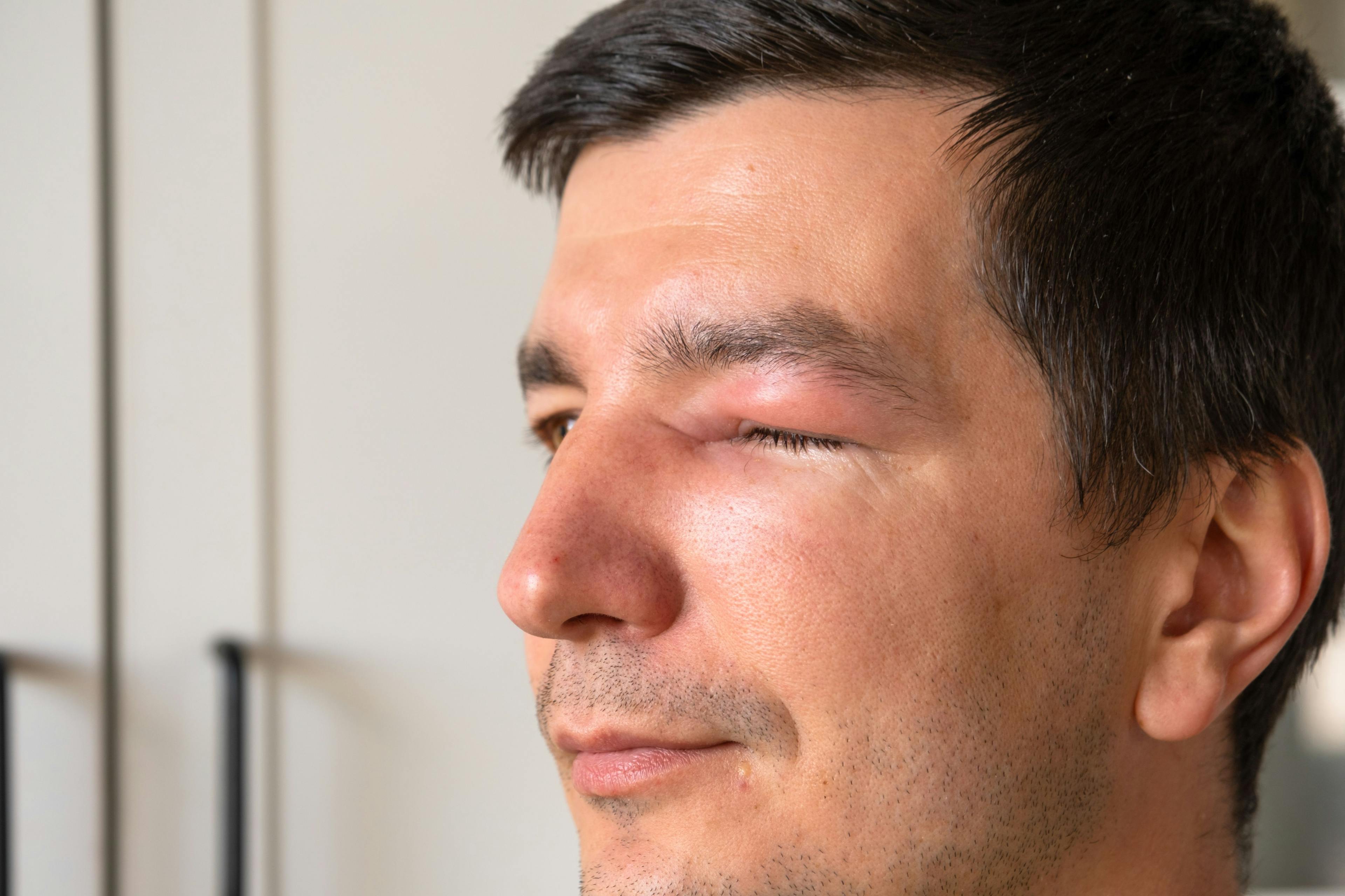 Man experiencing swelling in face