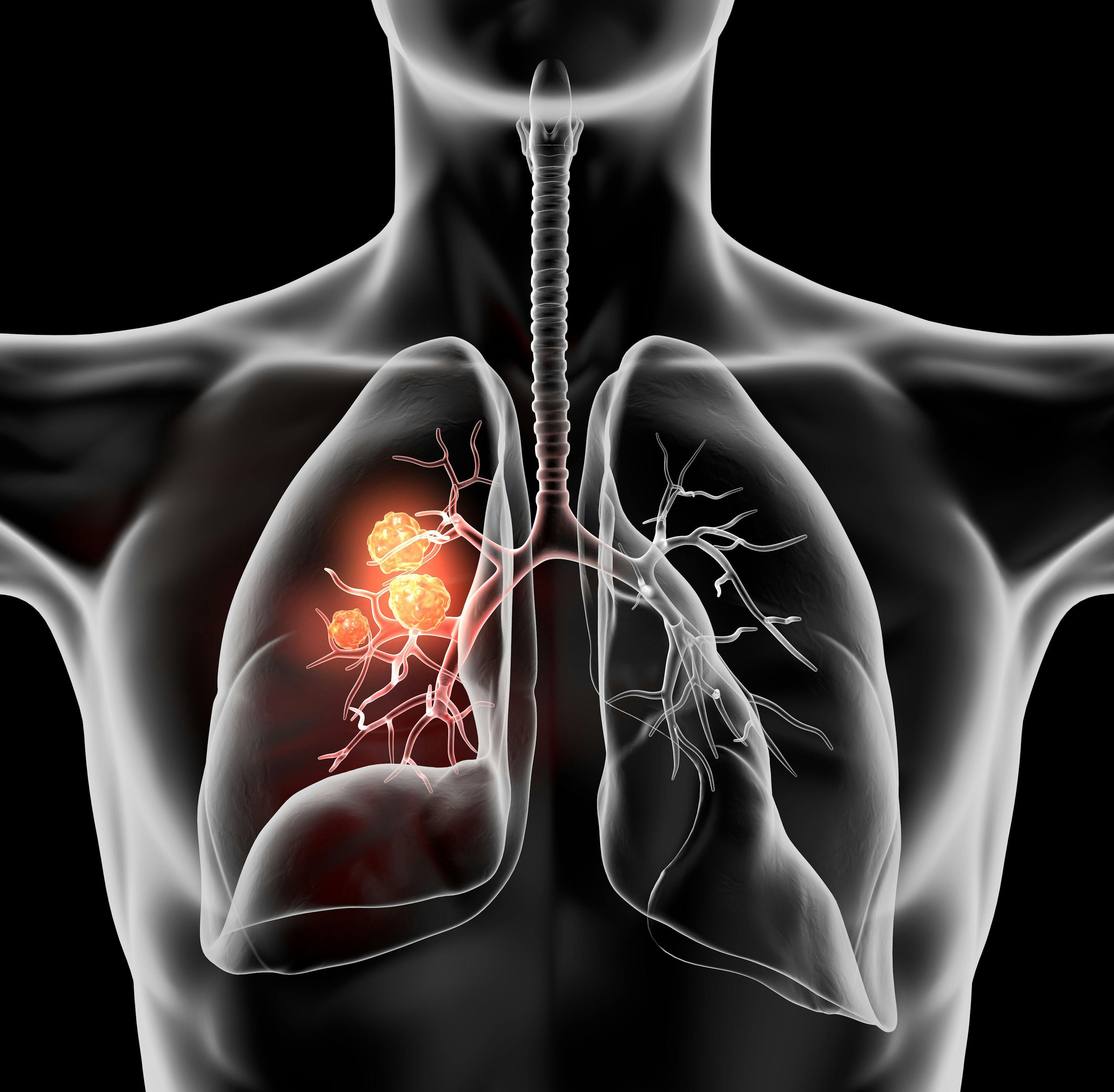Expert Discusses PD-1 Inhibitors as Treatment of NSCLC