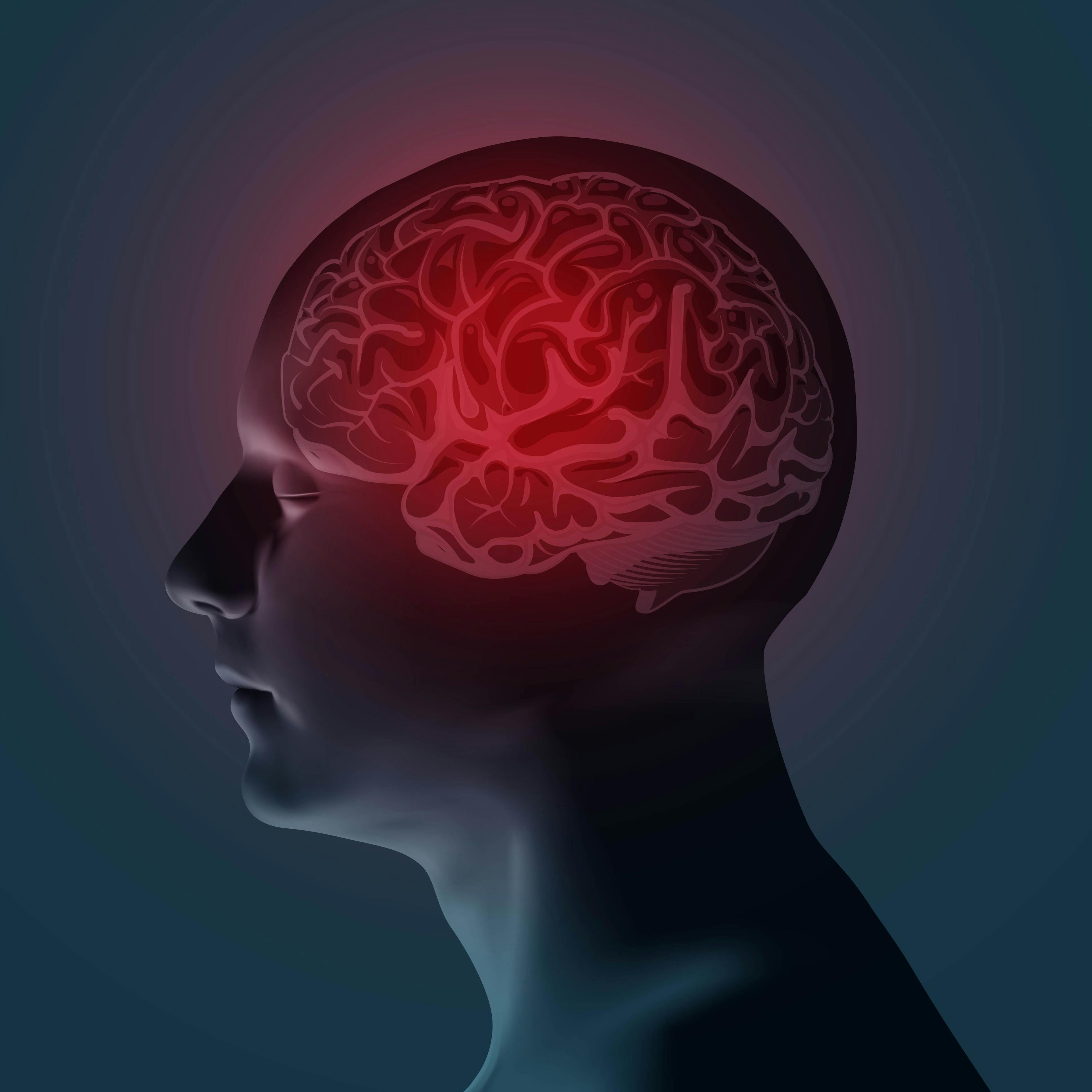 Erenumab Monotherapy Shows Sustained Long-Term Efficacy in Patients With Episodic Migraine