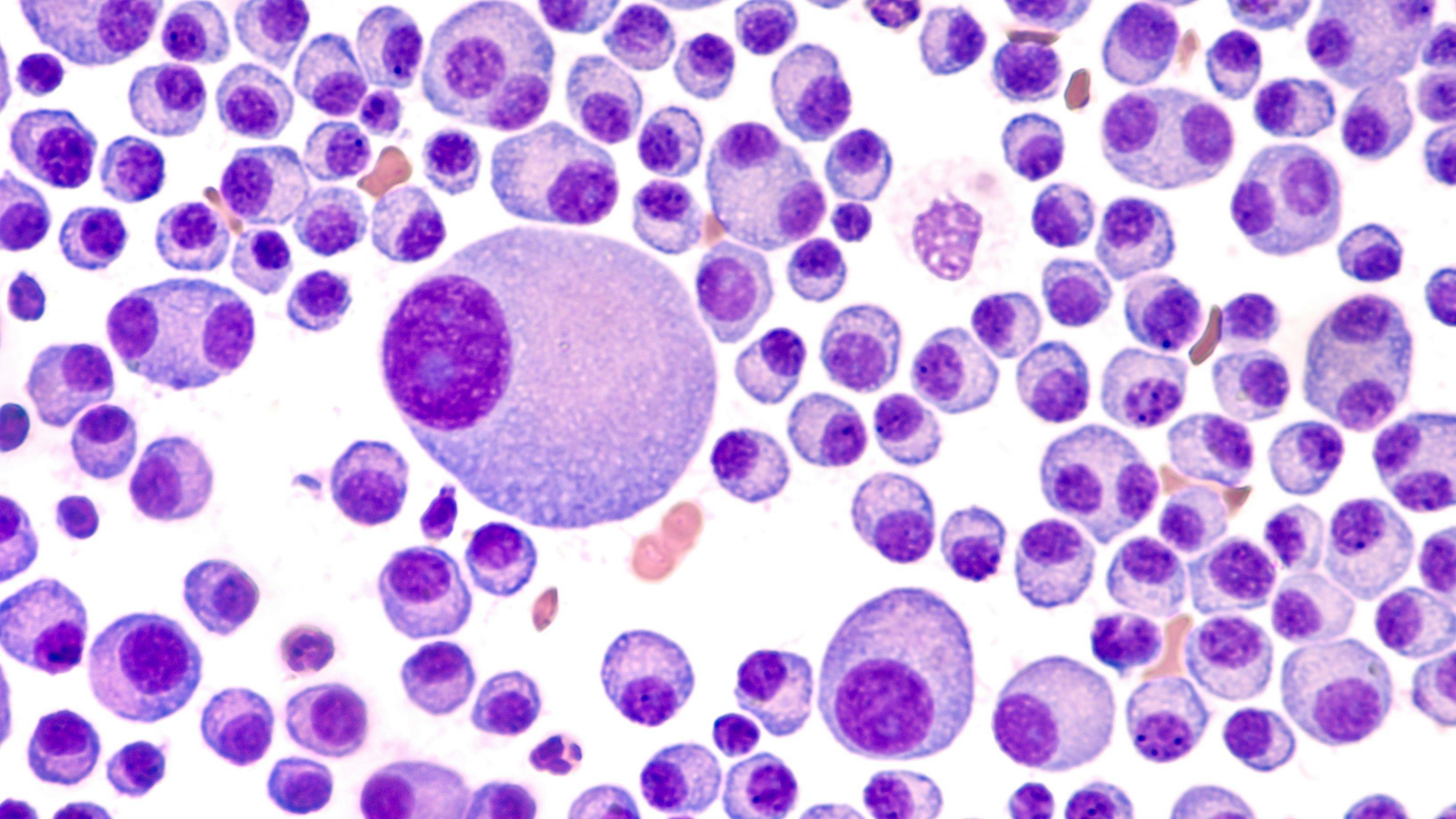 Prognostic Model Based on Tumor Immune Cell Infiltration Score May Predict Prognosis in Multiple Myeloma