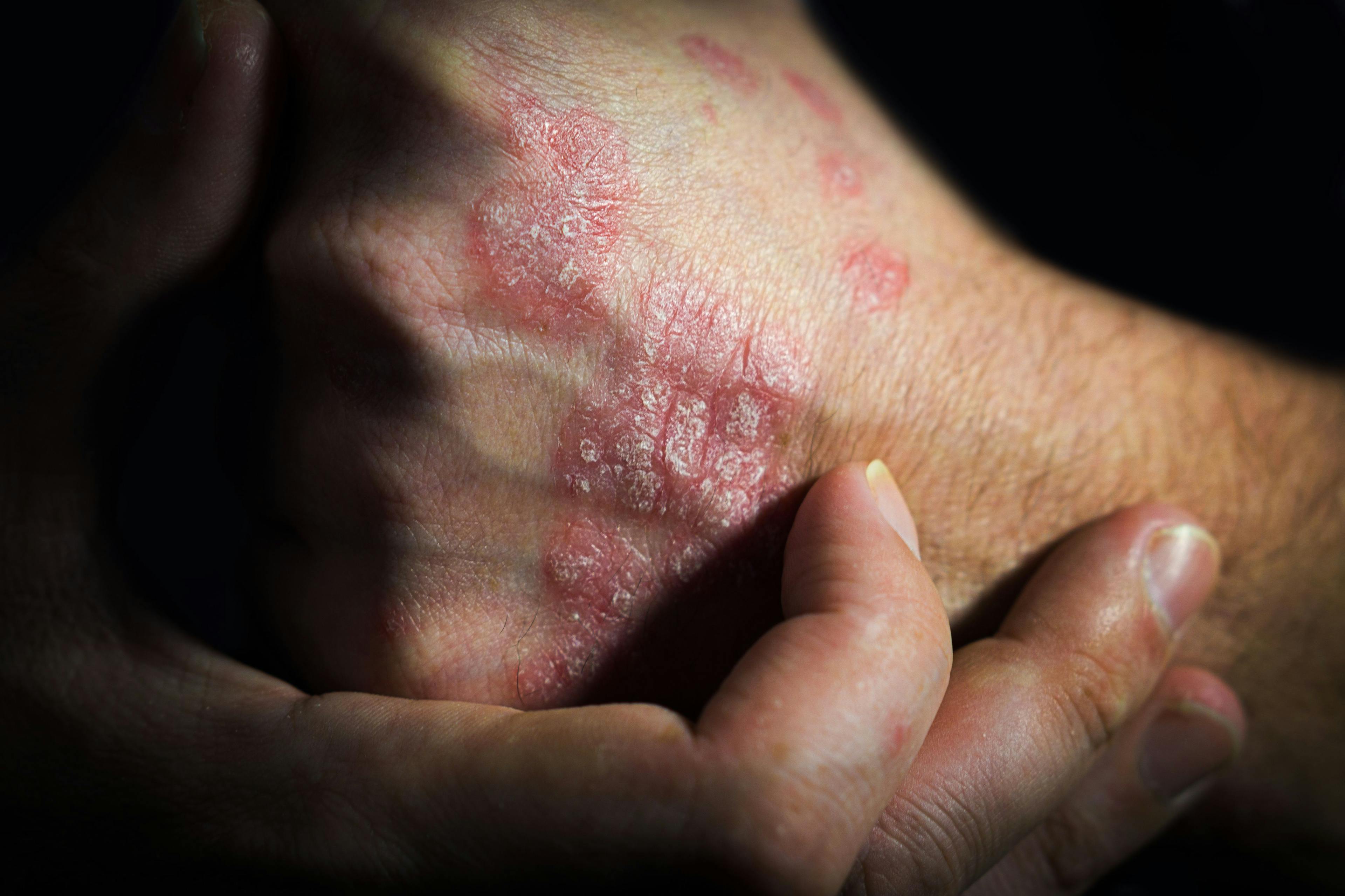 a man holds a hand at a psoriasis affected area of the skin | Image Credit SergeVo - stock.adobe.com