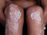 Psoriasis May Offer Clues About Type 2 Diabetes Risk