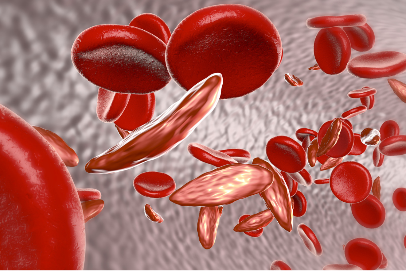 Importance of Sickle Cell Awareness Month Highlighted by Lack of Funding, Treatment Options