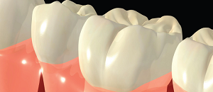 Drug-Induced Gingival Overgrowth: More than a Cosmetic Issue
