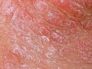 Plaque Psoriasis Drug Shows Strong Efficacy Versus Competitors