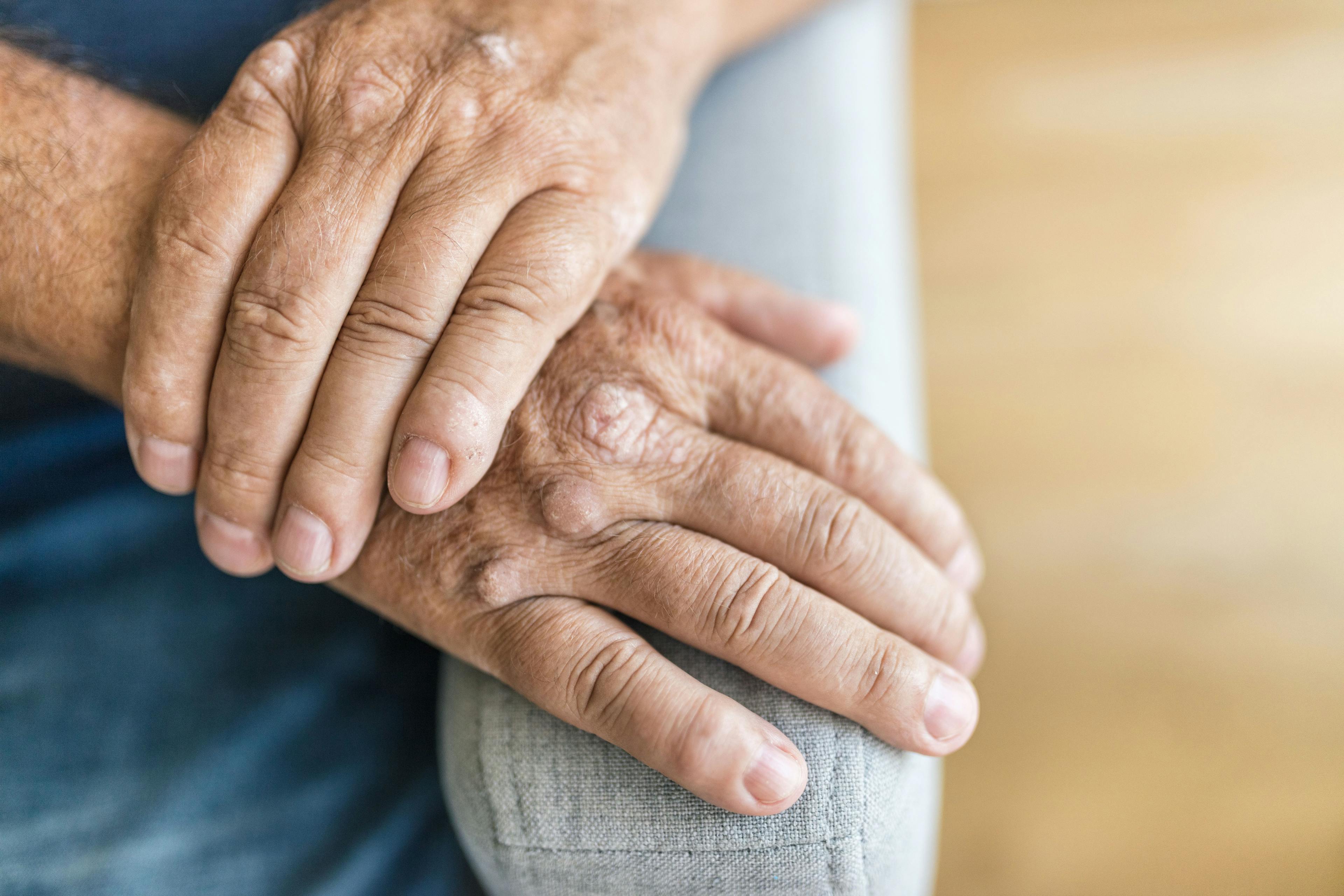 Elderly man suffering from psoriasis on hands | Image Credit: and.one - stock.adobe.com