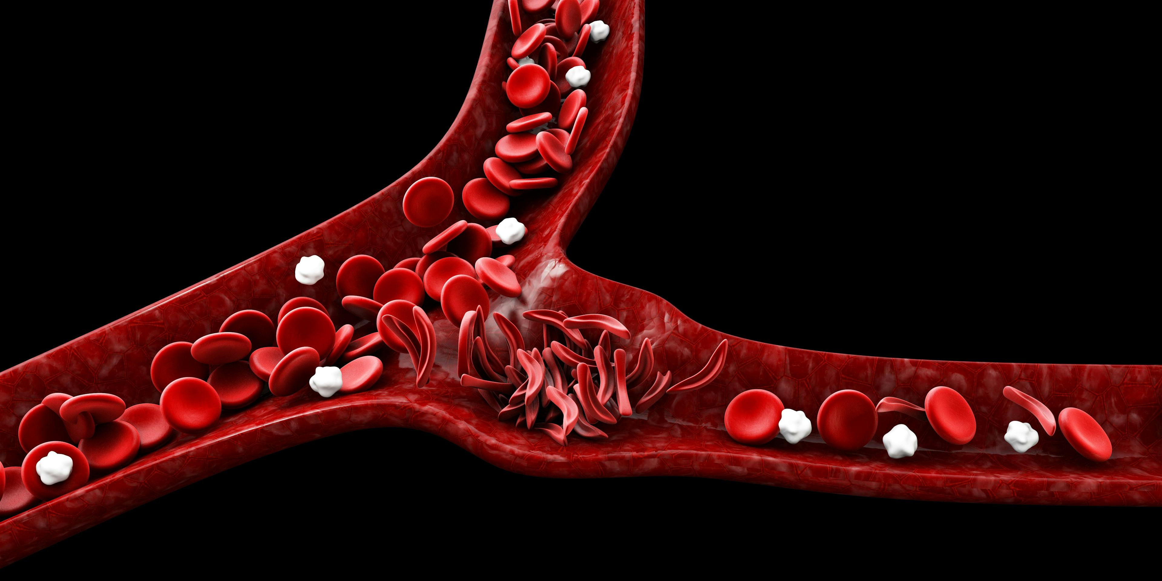 Sickle cell anemia, 3D illustration showing blood vessel with normal and deformed crescent - Image credit: Tussik | stock.adobe.com 