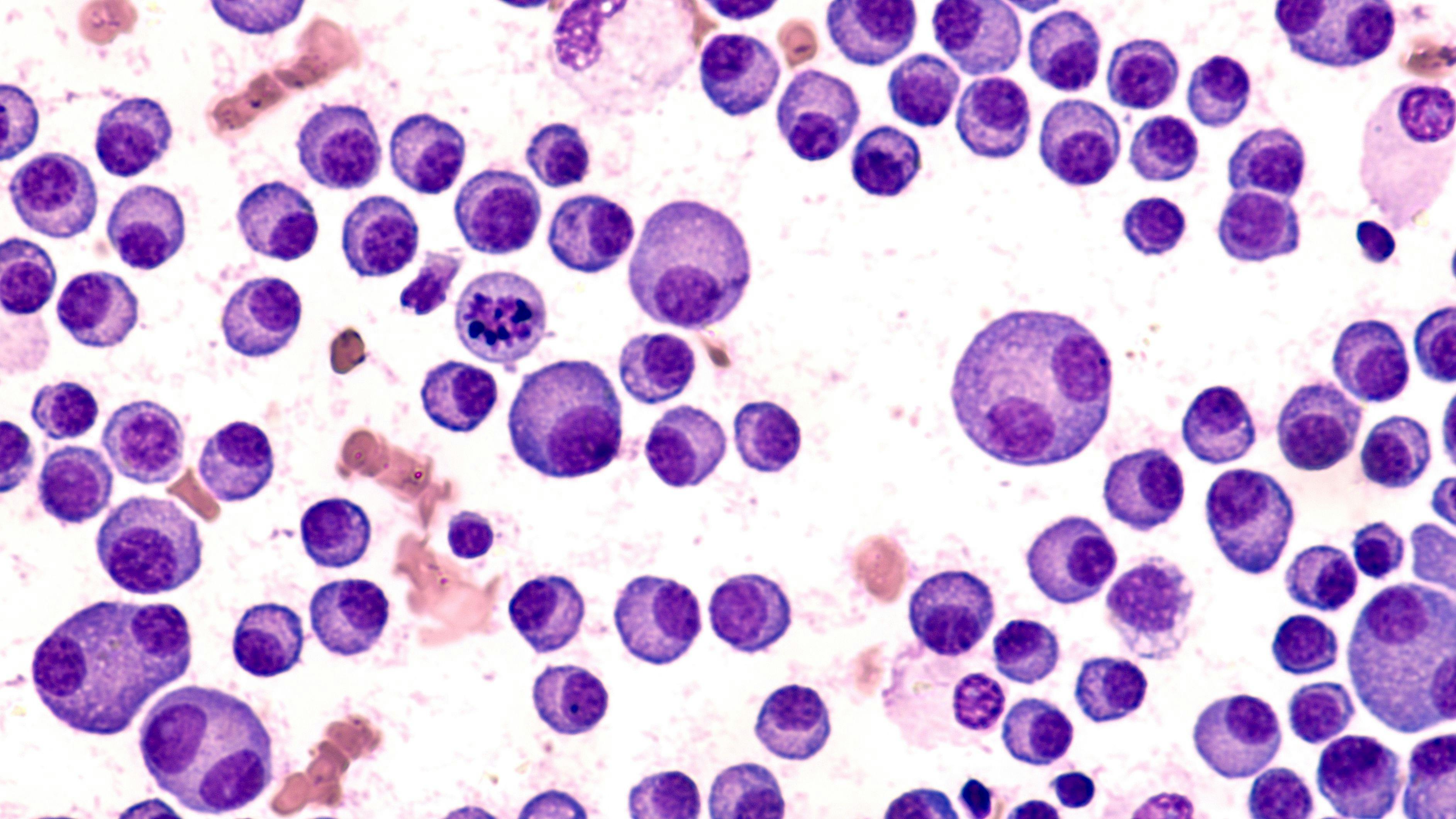 Multiple Myeloma Awareness: Bone marrow aspirate cytology of multiple myeloma, a type of bone marrow cancer of malignant plasma cells, associated with bone pain, bone fractures and anemia