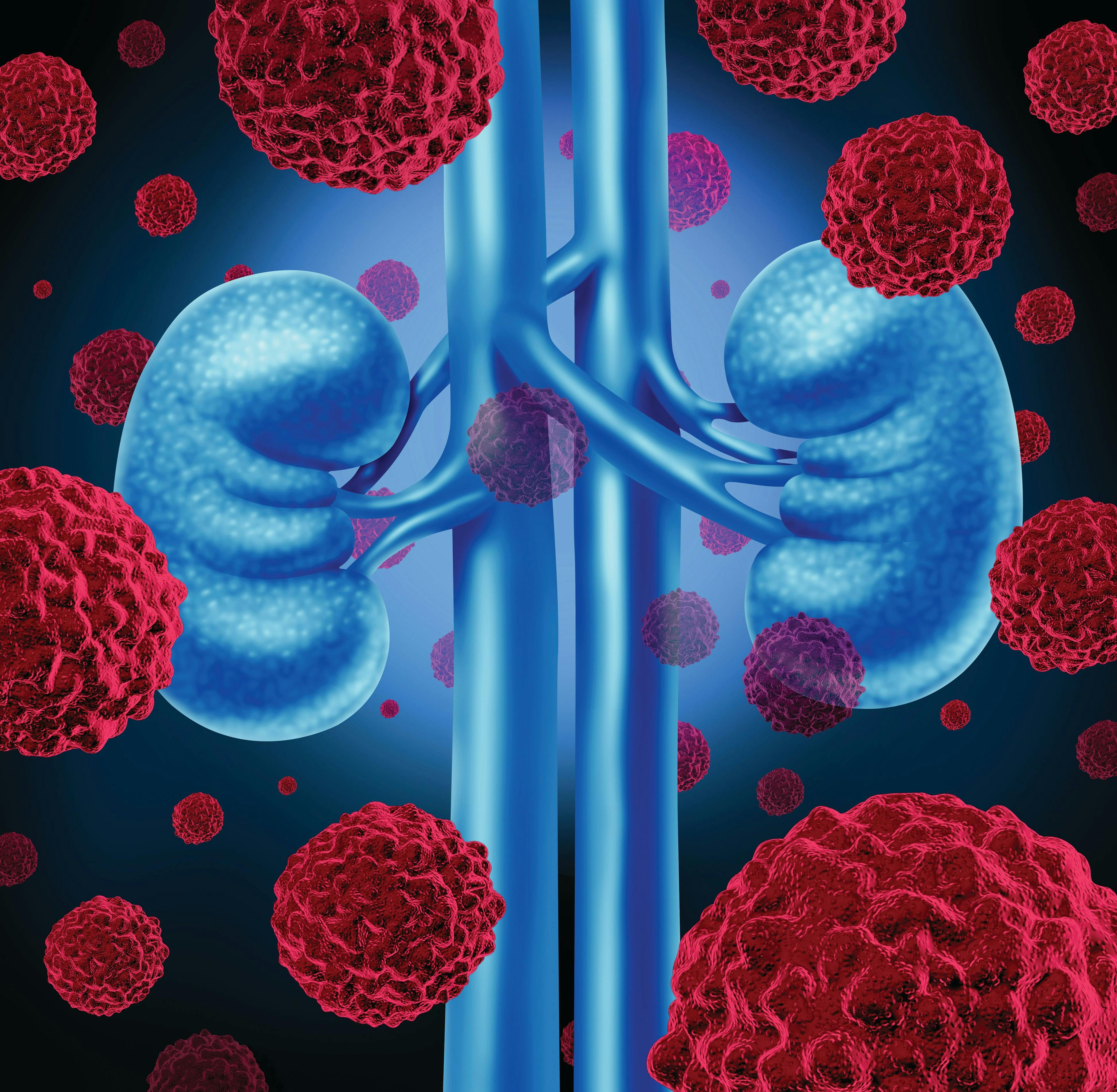 Finerenone May Protect Patients With Chronic Kidney Disease From Pneumonia-Related Severe Adverse Events