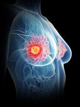 FDA Approves Diagnostic Test to Identify Patients with Metastatic Breast Cancer Expressing Low Levels of HER2 Protein