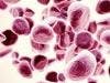 FDA Grants Priority Review to Multiple Myeloma Treatment